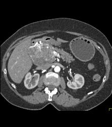 Serous Cystadenoma With Prominent Vessels Around the Head of the Pancreas - CTisus CT Scan