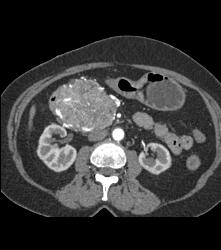 Serous Cystadenoma With Prominent Vessels Around the Head of the Pancreas - CTisus CT Scan