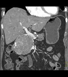 Serous Cystadenoma With Prominent Vessels Around the Head of the Pancreas - CTisus CT Scan