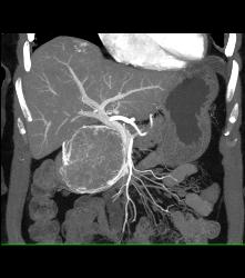 Serous Cystadenoma With Prominent Vessels Around the Head of the Pancreas - CTisus CT Scan