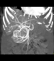 Serous Cystadenoma With Prominent Vessels Around the Head of the Pancreas - CTisus CT Scan