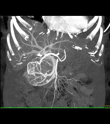 Serous Cystadenoma With Prominent Vessels Around the Head of the Pancreas - CTisus CT Scan