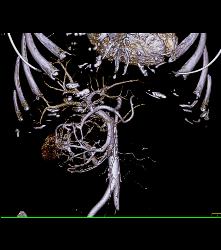 Serous Cystadenoma With Prominent Vessels Around the Head of the Pancreas - CTisus CT Scan