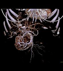 Serous Cystadenoma With Prominent Vessels Around the Head of the Pancreas - CTisus CT Scan