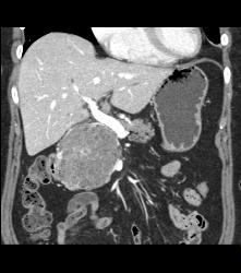 Serous Cystadenoma With Prominent Vessels Around the Head of the Pancreas - CTisus CT Scan