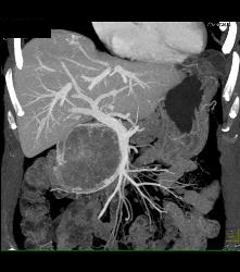 Serous Cystadenoma With Prominent Vessels Around the Head of the Pancreas - CTisus CT Scan