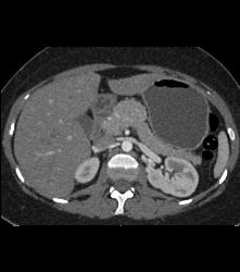 Atypical Islet Cell Tumor of the Body of the Pancreas - CTisus CT Scan