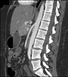 Atypical Islet Cell Tumor of the Body of the Pancreas - CTisus CT Scan