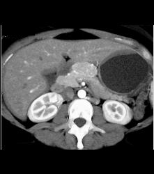 Atypical Islet Cell Tumor of the Body of the Pancreas - CTisus CT Scan