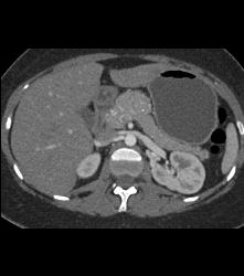 Atypical Islet Cell Tumor of the Body of the Pancreas - CTisus CT Scan