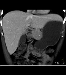 Atypical Islet Cell Tumor of the Body of the Pancreas - CTisus CT Scan