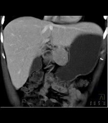 Atypical Islet Cell Tumor of the Body of the Pancreas - CTisus CT Scan