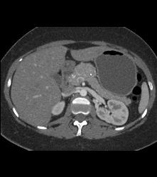 Castleman Disease - CTisus CT Scan