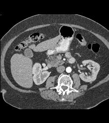 Fatty Infiltration of the Pancreas Simulates A Mass - CTisus CT Scan