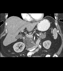 Fatty Infiltration of the Pancreas Simulates A Mass - CTisus CT Scan