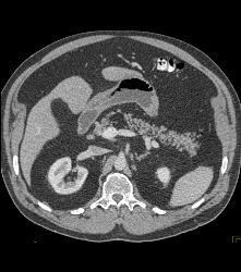 Pancreatic Lipoma - CTisus CT Scan