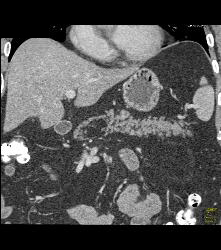 Pancreatic Lipoma - CTisus CT Scan