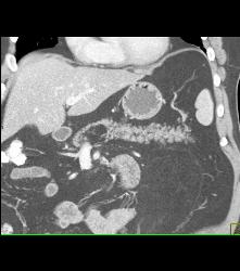 Pancreatic Lipoma - CTisus CT Scan