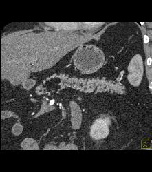 Pancreatic Lipoma - CTisus CT Scan