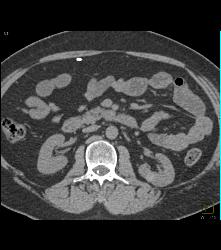 Subtle Islet Cell Tumor of the Pancreatic Head- See Full Sequence - CTisus CT Scan