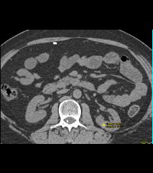 Subtle Islet Cell Tumor of the Pancreatic Head- See Full Sequence - CTisus CT Scan