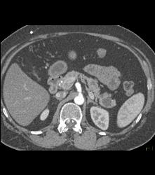 Subtle Islet Cell Tumor of the Pancreatic Head- See Full Sequence - CTisus CT Scan