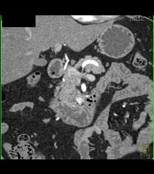 Subtle Islet Cell Tumor of the Pancreatic Head- See Full Sequence - CTisus CT Scan