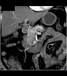 Subtle Islet Cell Tumor of the Pancreatic Head- See Full Sequence - CTisus CT Scan