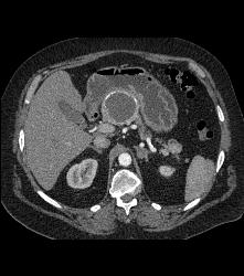 Cystic Islet Cell Tumor - CTisus CT Scan