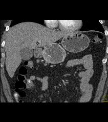 Cystic Islet Cell Tumor - CTisus CT Scan