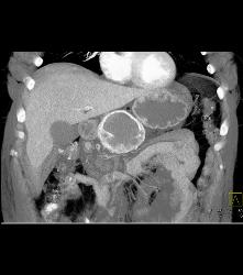 Cystic Islet Cell Tumor - CTisus CT Scan