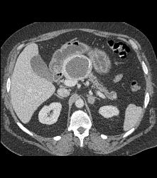 Cystic Islet Cell Tumor - CTisus CT Scan