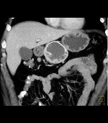 Cystic Islet Cell Tumor - CTisus CT Scan