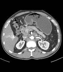 Pancreatic Cancer With Nodes and Duodenal Diverticulum - CTisus CT Scan