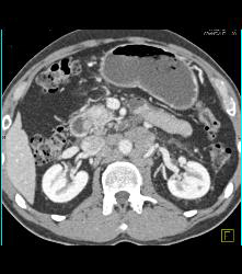 Pancreatic Cancer With Nodes and Duodenal Diverticulum - CTisus CT Scan