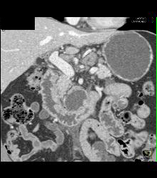 Pancreatic Cancer With Nodes and Duodenal Diverticulum - CTisus CT Scan