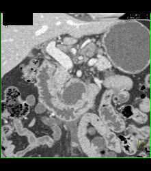 Pancreatic Cancer With Nodes and Duodenal Diverticulum - CTisus CT Scan