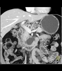 Tiny Cysts in Head of Pancreas - CTisus CT Scan