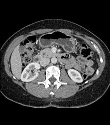 Tiny Cysts in Head of Pancreas - CTisus CT Scan