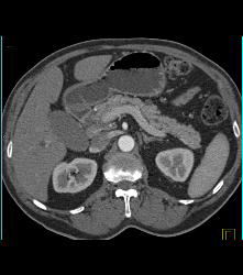 Tiny Cysts in Head of Pancreas - CTisus CT Scan