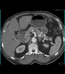 Tiny Cysts in Head of Pancreas - CTisus CT Scan