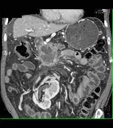 Pancreatic Cancer With Vessel Enhancement Especially PV/SMV/SV - CTisus CT Scan