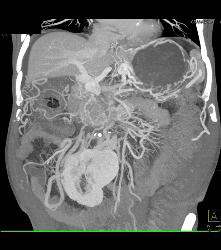 Pancreatic Cancer With Vessel Enhancement Especially PV/SMV/SV - CTisus CT Scan