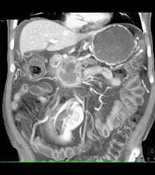 Pancreatic Cancer With Vessel Enhancement Especially PV/SMV/SV - CTisus CT Scan