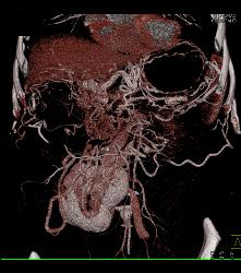 Pancreatic Cancer With Vessel Enhancement Especially PV/SMV/SV - CTisus CT Scan