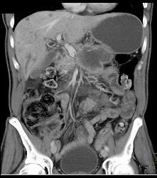 Pancreatic Cancer With Vessel Enhancement Especially PV/SMV/SV - CTisus CT Scan