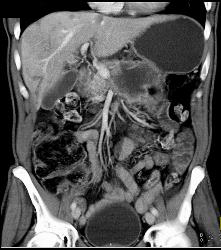 Pancreatic Cancer With Vessel Enhancement Especially PV/SMV/SV - CTisus CT Scan