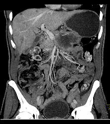 Pancreatic Cancer With Vessel Enhancement Especially PV/SMV/SV - CTisus CT Scan