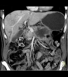 Pancreatic Cancer With Vessel Enhancement Especially PV/SMV/SV - CTisus CT Scan