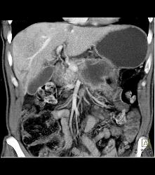 Pancreatic Cancer With Vessel Enhancement Especially PV/SMV/SV - CTisus CT Scan